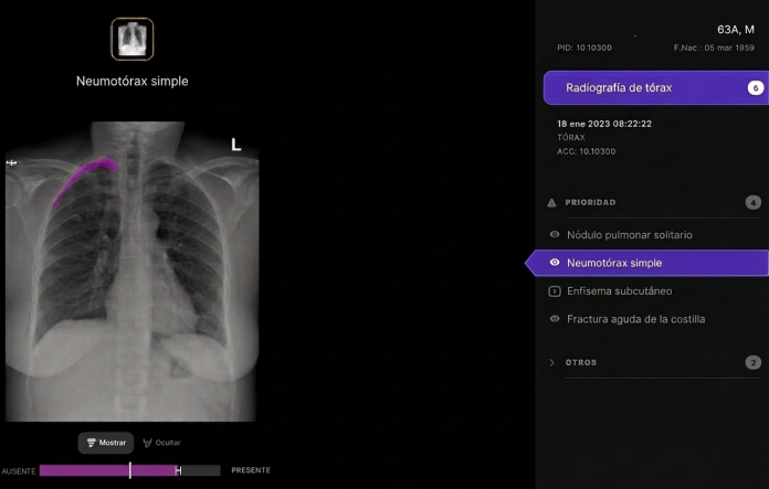 Telefónica, Harrison.ai partner to support the diagnosis of chest X-rays using AI